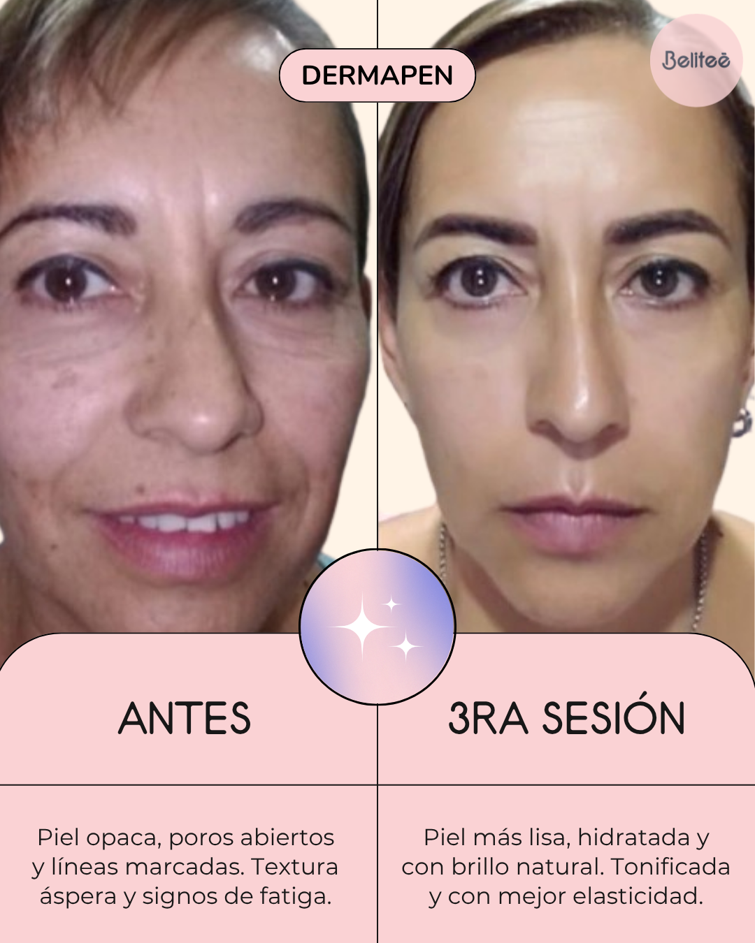 Curso Microneedling Avanzado