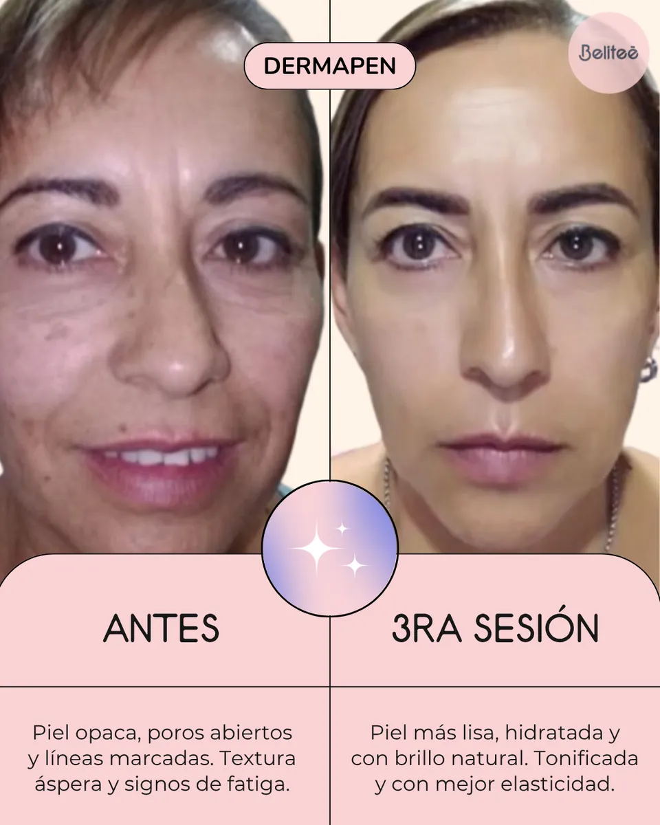 Curso de microneedling avanzado